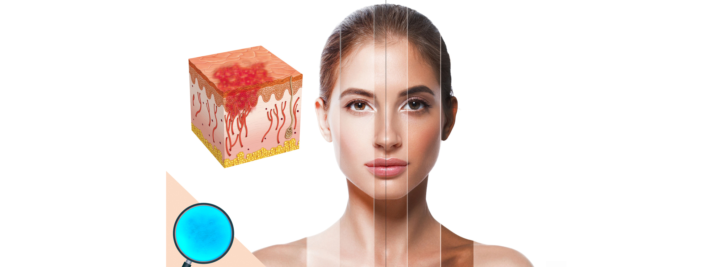 What are the symptoms of rosacea?
